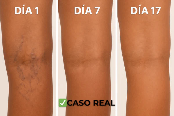Parches Naturales para las Varices y para las Piernas Cansadas - VeinPatch™