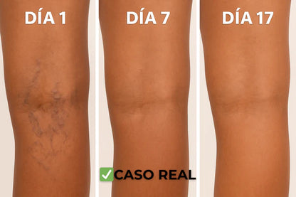 Parches Naturales para las Varices y para las Piernas Cansadas - VeinPatch™