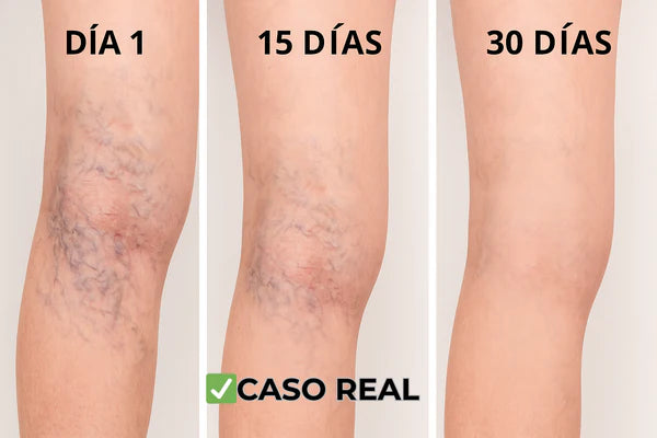 Parches Naturales para las Varices y para las Piernas Cansadas - VeinPatch™